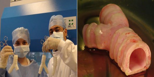 醫學界新突破:瑞典完成世界首例人造器官移植