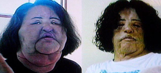 韓模特整容成癮 自行注射食用油成“站著的風扇”